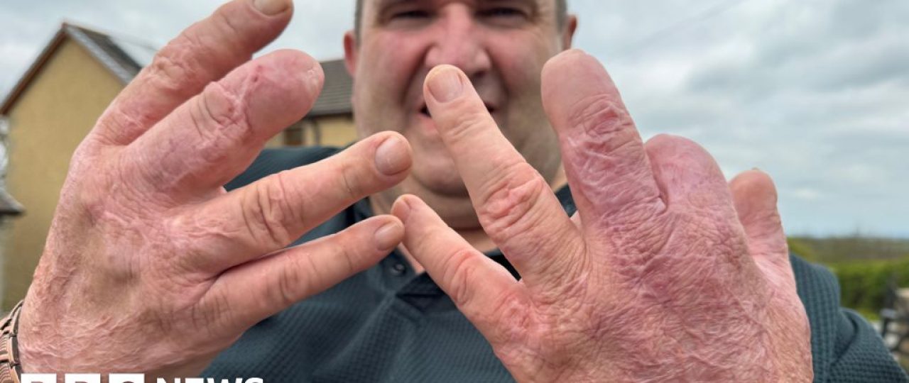 ‘I was given a choice – keep my legs or keep my life’ – the sepsis patient who lived