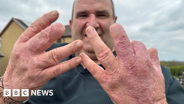 ‘I was given a choice – keep my legs or keep my life’ – the sepsis patient who lived