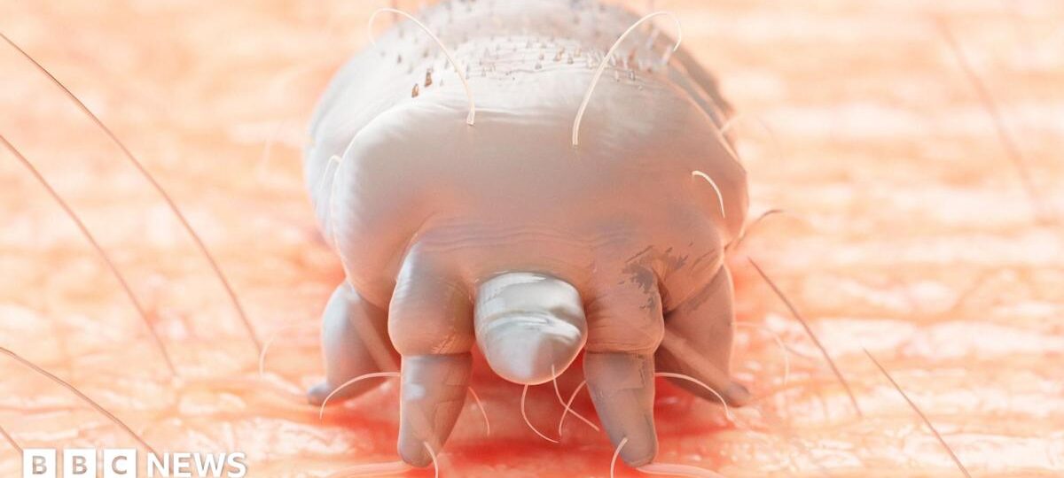 Rare crusted scabies outbreak shuts hospital ward