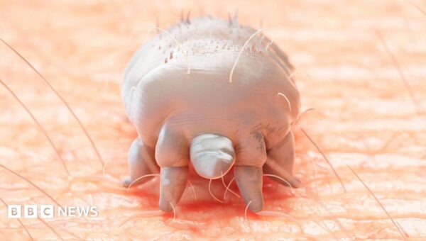 Rare crusted scabies outbreak shuts hospital ward