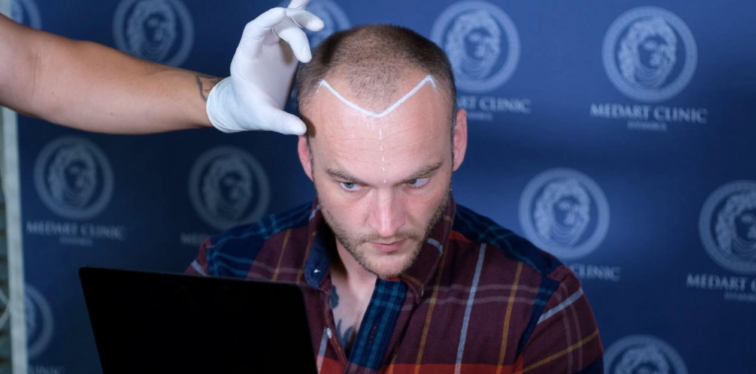 Top 5 Doctor-Led vs Top 5 High-Volume Hair Transplant Turkey Clinics for Complex Cases 2026