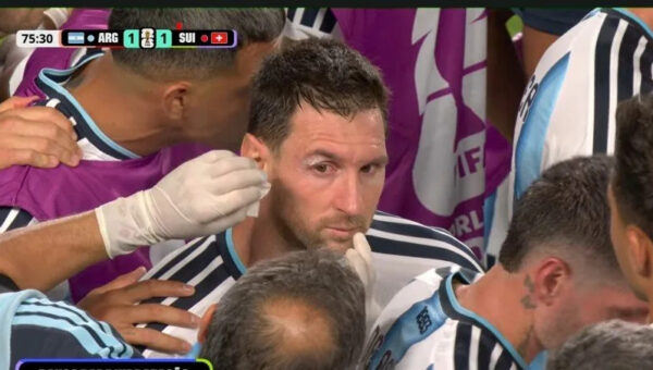 Messi bloodied above the eye, treated on the touchline