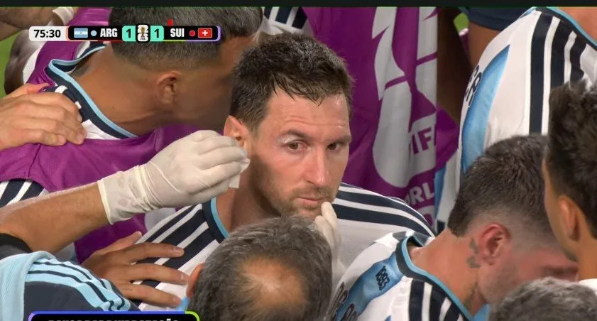 Messi bloodied above the eye, treated on the touchline