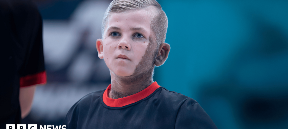Birthmark no barrier for young footballing TV star