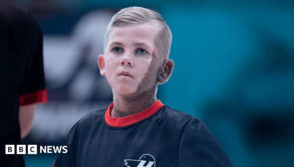 Birthmark no barrier for young footballing TV star