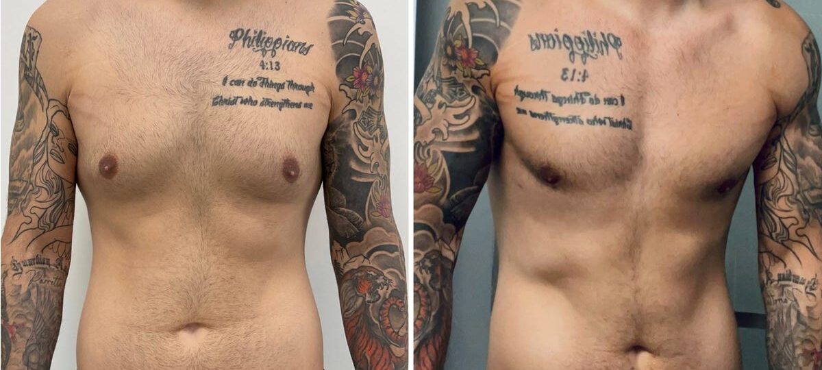 Men get cosmetic surgery, too. I spent $14,000 on plastic surgery, and I don't regret it.
