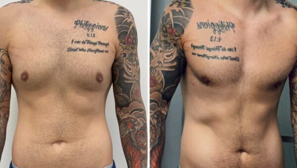 Men get cosmetic surgery, too. I spent $14,000 on plastic surgery, and I don’t regret it.