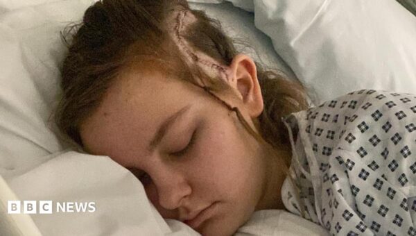 Girl ‘youngest’ to have conscious brain surgery for condition