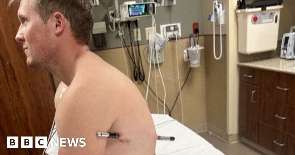 Man impaled by a hiking pole treks 10 miles down mountain