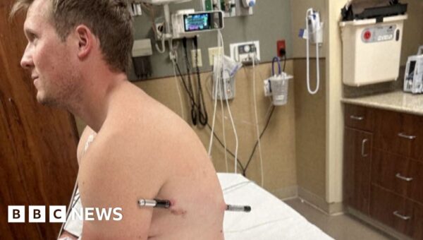 Man impaled by a hiking pole treks 10 miles down mountain