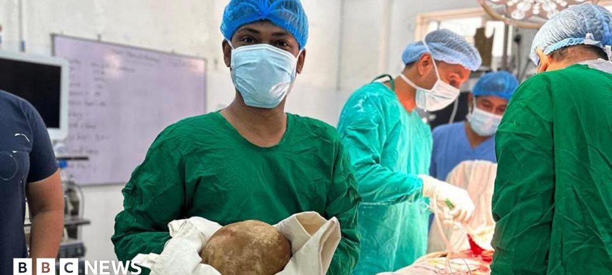 Doctors remove 3.1kg stone from man's bladder and claim record