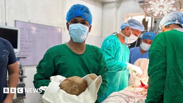 Doctors remove 3.1kg stone from man’s bladder and claim record