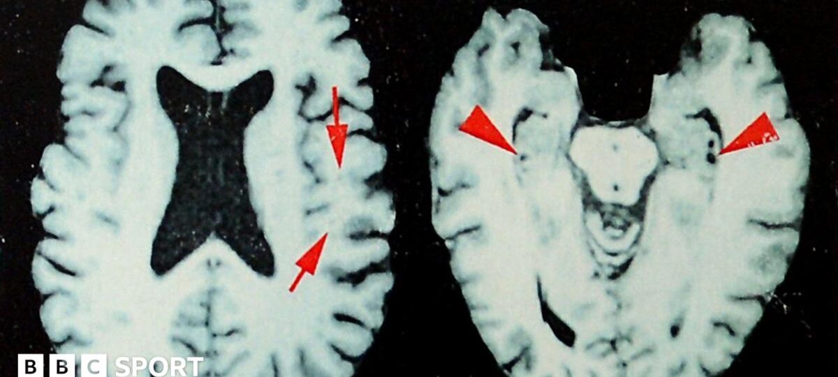 Brain disease in dead NFL players 'higher than previously shown'