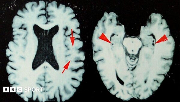 Brain disease in dead NFL players ‘higher than previously shown’