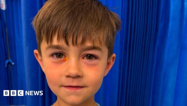 Boy, four, taken to hospital after Shein fake squishy toy explodes in his face