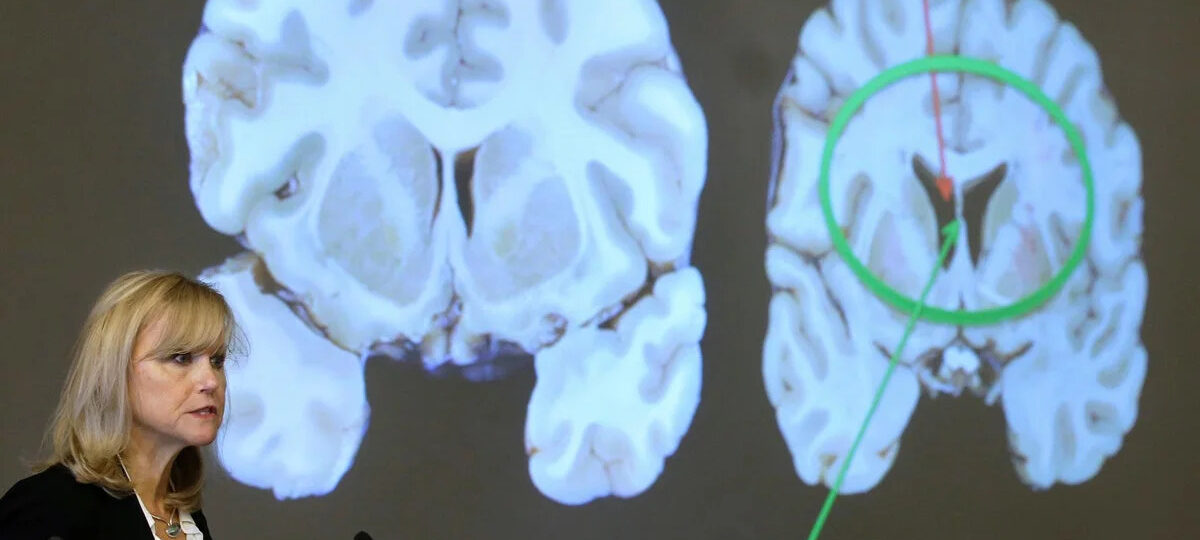 One in four NFL players could get CTE, alarming new study finds