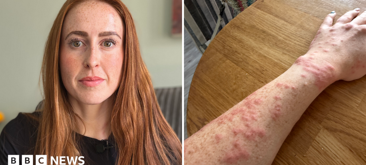 Woman attacked by bed bugs during Travelodge stay