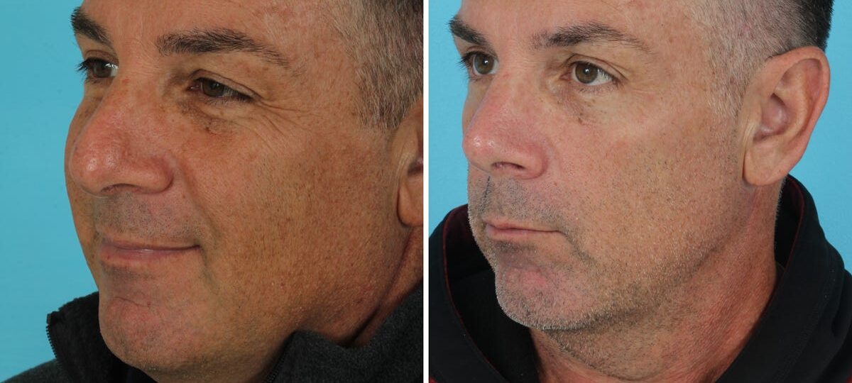 I'm a retired firefighter. I spent $14,000 on plastic surgery in my 50s, and I'm not ashamed.