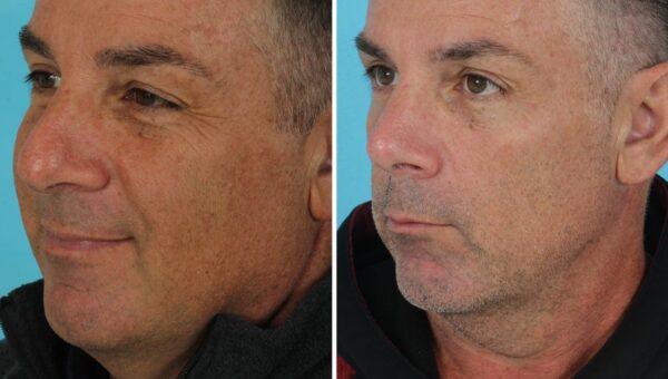 I'm a retired firefighter. I spent $14,000 on plastic surgery in my 50s, and I'm not ashamed.