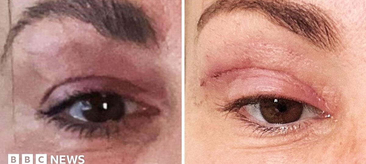 'My eyelids became infected - I was scared to sleep'