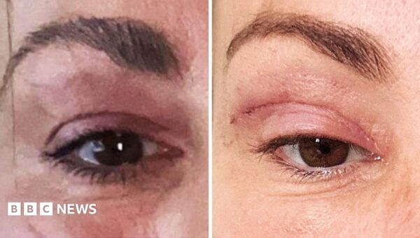 ‘My eyelids became infected – I was scared to sleep’