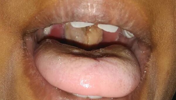 Plateau Diphtheria death toll hits 27 as 303 cases recorded