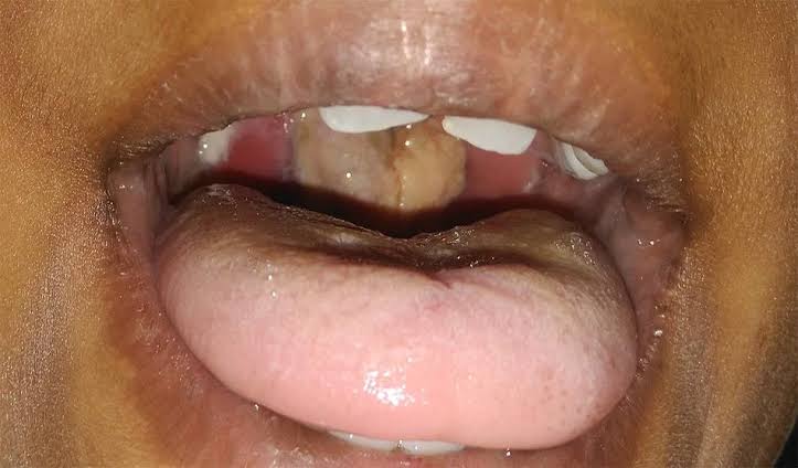 Plateau Diphtheria death toll hits 27 as 303 cases recorded