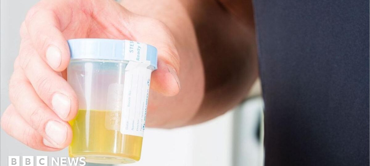 Urine test can spot more than nine in 10 bladder cancers
