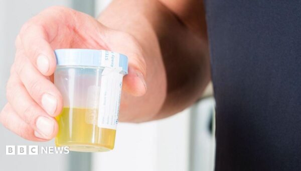 Urine test can spot more than nine in 10 bladder cancers