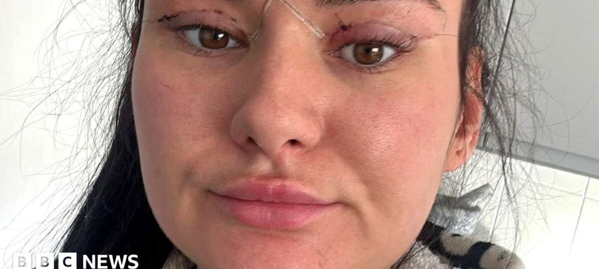 Open wounds and eyes that can't close - women warn about cheap bleph eyelid surgery