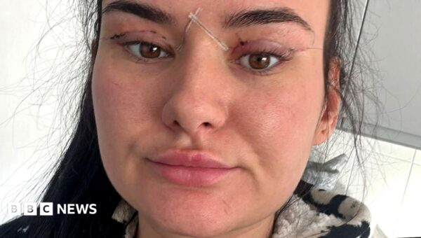 Open wounds and eyes that can’t close – women warn about cheap bleph eyelid surgery