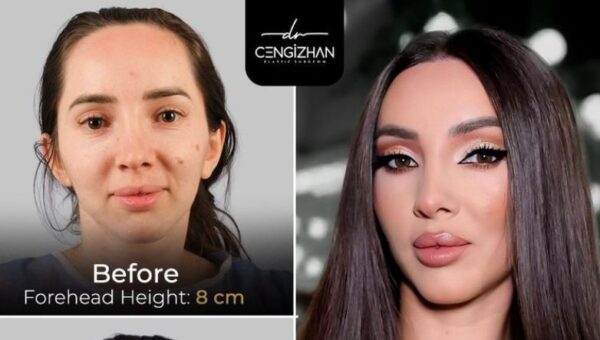 Forehead Reduction Surgery Turkey: Creating a Lower Hairline for More Balanced Facial Proportions