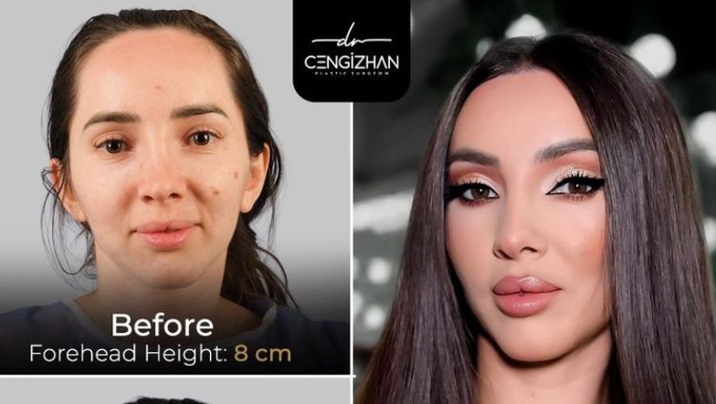 Forehead Reduction Surgery Turkey: Creating a Lower Hairline for More Balanced Facial Proportions