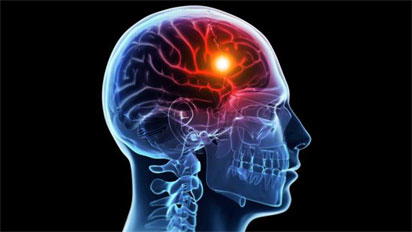 ‘One in 4 Nigerian stroke patients under 50’