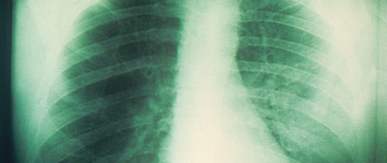 What Is Pneumonic Plague? Symptoms of the Lung Infection