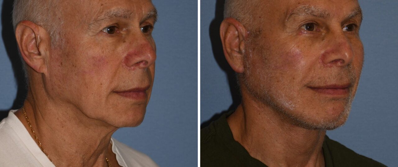 I’m a 72-year-old grandfather and spent $60,000 on a facelift and other cosmetic procedures. People now think I’m in my 50s.
