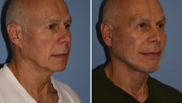I’m a 72-year-old grandfather and spent $60,000 on a facelift and other cosmetic procedures. People now think I’m in my 50s.