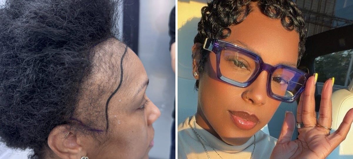I couldn't afford a $13,000 hair transplant in the US. So I flew to Turkey and I love the results.