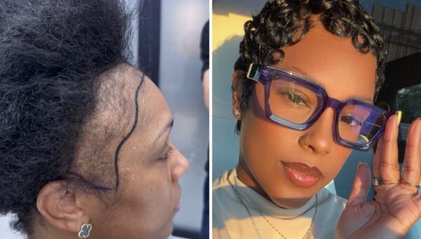 I couldn't afford a $13,000 hair transplant in the US. So I flew to Turkey and I love the results.