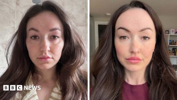 Is ‘ferritin face’ a real thing – and can you really spot low iron from looks?