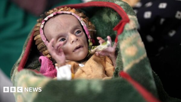 Newborn twins fight for survival as conflict fuels Yemen’s hunger crisis